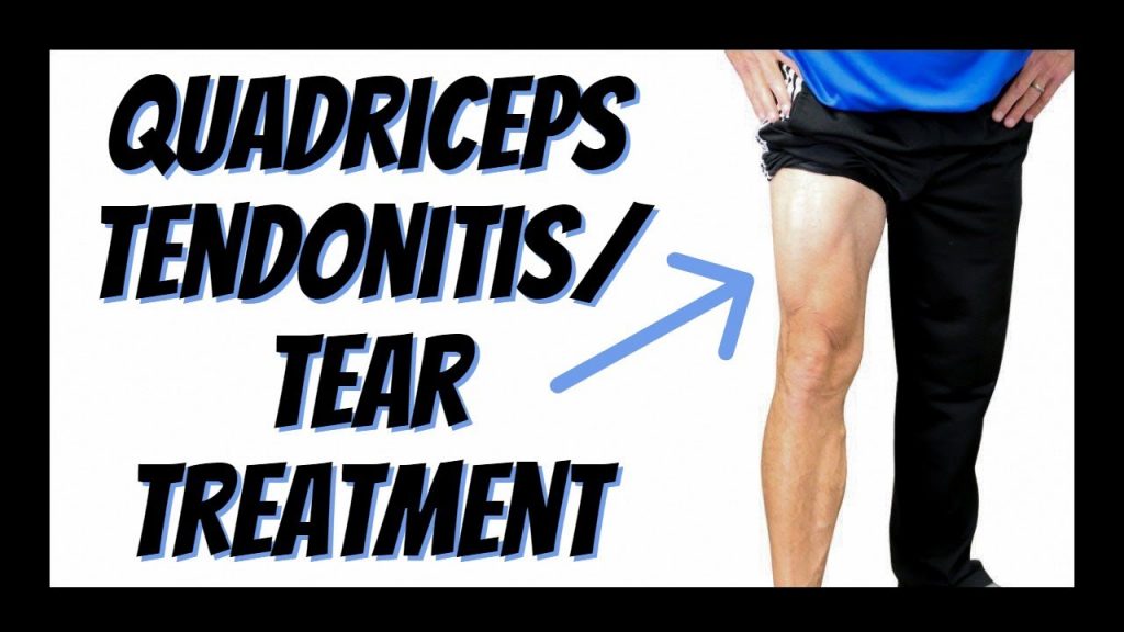 Effective Self-Treatment for Quadriceps Tendonitis or Tear: Updated Tips Effective Self-Treatment for Quadriceps Tendonitis or Tear: Updated Tips