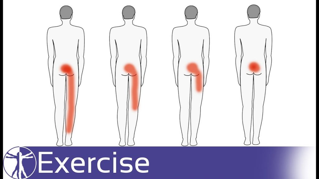 Effective Exercises for Alleviating Low Back Pain Based on Directional Preference