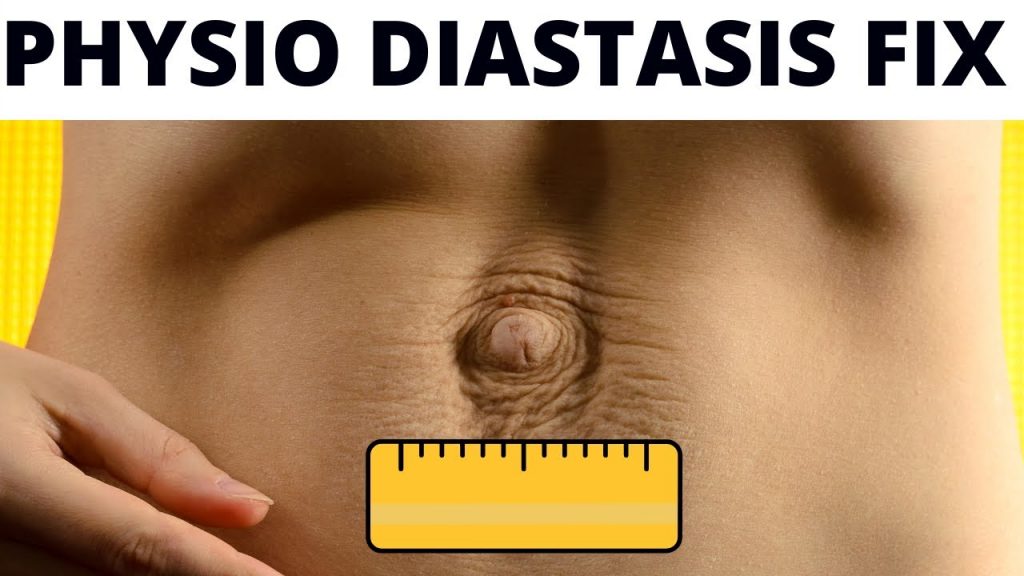 “Efficient Ways to Heal Diastasis Recti: Comprehensive Physiotherapy Guide for a Flatter Belly” “Efficient Ways to Heal Diastasis Recti: Comprehensive Physiotherapy Guide for a Flatter Belly”