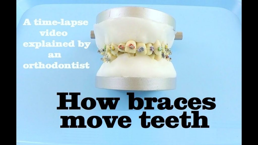 How Braces Move Teeth: Explained with Time-Lapse Footage How Braces Move Teeth: Explained with Time-Lapse Footage