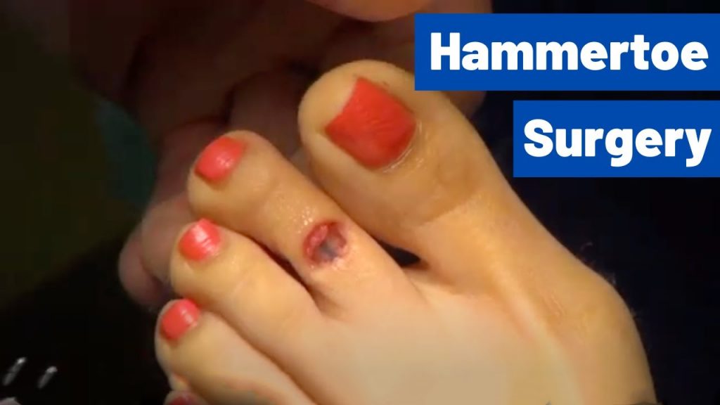 “Surgery for Hammertoe: Straightening and Shortening Your Toes with Dr. Moore’s Inion Pin Technique” “Surgery for Hammertoe: Straightening and Shortening Your Toes with Dr. Moore’s Inion Pin Technique”